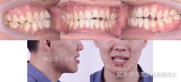 偏颌矫正手术多少钱（北京正畸杨磊博士）