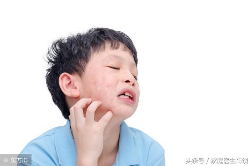 荨麻疹治疗多少钱（荨麻疹可以治愈吗）