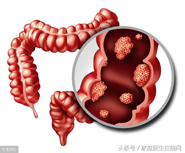 直肠息肉手术多少钱（检查出直肠息肉该怎么办）