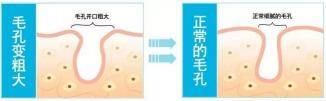 像素激光祛痘多少钱（毛孔粗大之后真的不可逆吗）