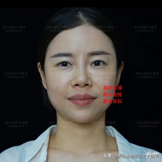 自体肋软骨隆鼻术多少钱（通过肋软骨鼻修复术）