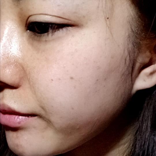 激光祛斑手术要多少钱（祛斑一定要找对方法）