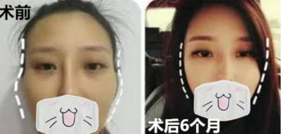 自体脂肪填充多少钱（填充攻略）