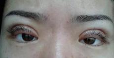双眼皮一般多少钱（双眼皮不满意是不是就能修复）