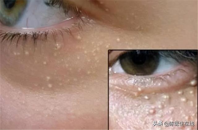 激光去脂肪粒多少錢（眼周的）