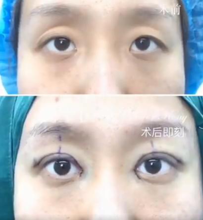 眼窝凹陷手术多少钱（凸眼球）