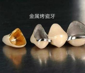 一个烤瓷牙套大概多少钱（做了烤瓷牙后）