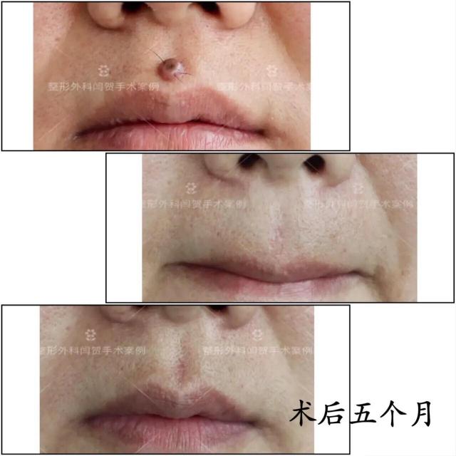 点黑痣要多少钱（去痣是选择激光点掉还是手术切除呢）