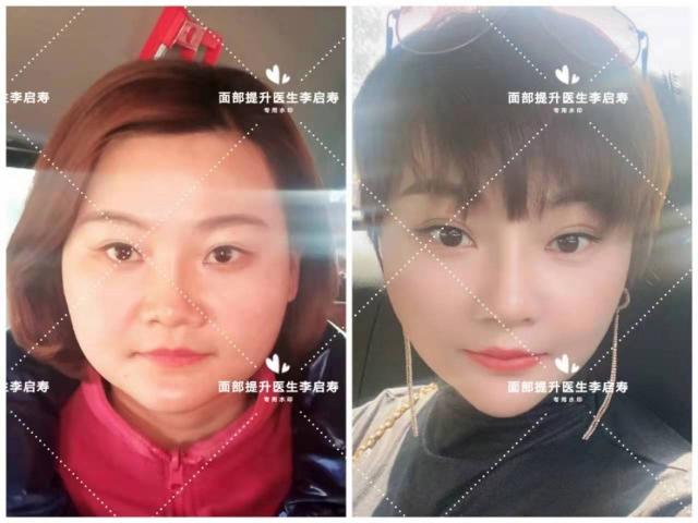 v臉提升多少錢(35歲大圓臉變小v臉)