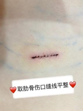 全半肋骨隆鼻多少钱（同是肋软骨隆鼻为啥还分全肋和半肋）