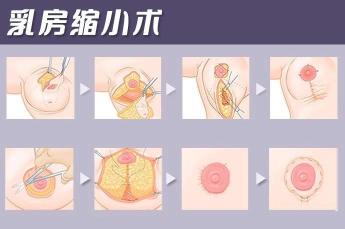 乳头缩小手术大约多少钱（乳房缩小整形术后效果怎么样）