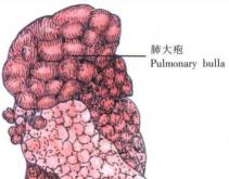 肺大泡手术多少钱（肺大泡肺气肿能不能根治）