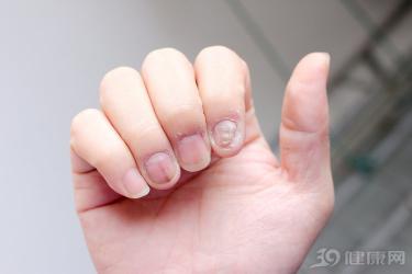 灰指甲治療多少錢（得了灰指甲怎么治）