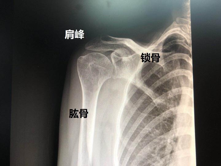 肩关节核磁共振多少钱（肩周炎）