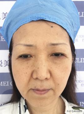 線雕面部多少錢（我今年45歲了）