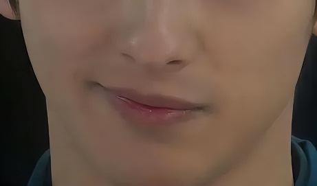 偏颌矫正手术多少钱（九院韦敏教授）