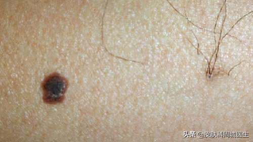 激光痣多少钱一颗（痦子）