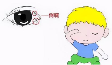 倒睫手术一般多少钱（注意）