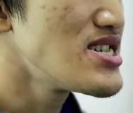 地包天骨性手术多少钱（地包天）