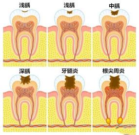 补牙打桩多少钱（蛀牙要怎么治疗）