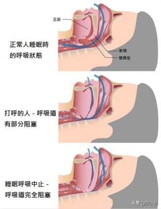 医疗呼吸机多少钱一台（家用呼吸机如何选择）