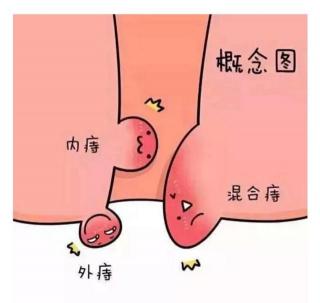 微创痔疮手术多少钱（小白就医记）