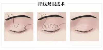 一般做双眼皮多少钱（高考完想去整形）