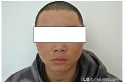 法医鉴定要多少钱（司法鉴定所对高坠伤致头面部损伤的法医临床鉴定）