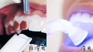 做冷光美白牙齿要多少钱（牙齿又黑又黄）